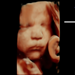 3d/4d/5d ultrasound