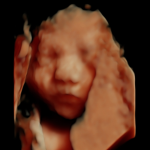 3d/4d/5d ultrasound