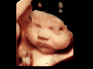 3d/4d/5d ultrasound