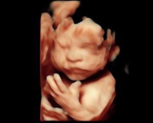 3d/4d/5d ultrasound